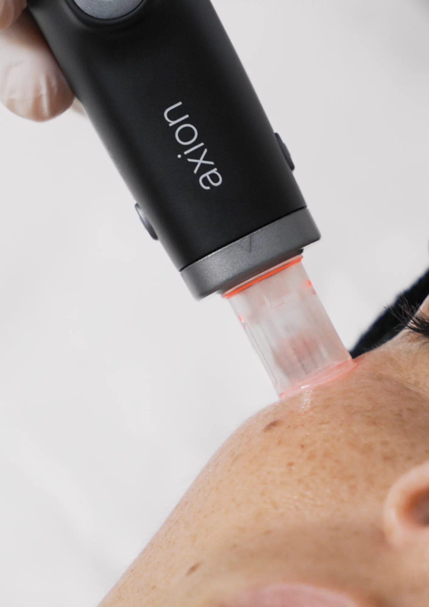 Microneedling